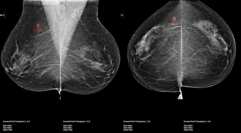 Transpara, an AI software for 2-D and 3-D mammography. A 2-D version of the software has received CE and FDA approval. 